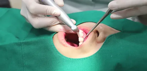 牙面抛光