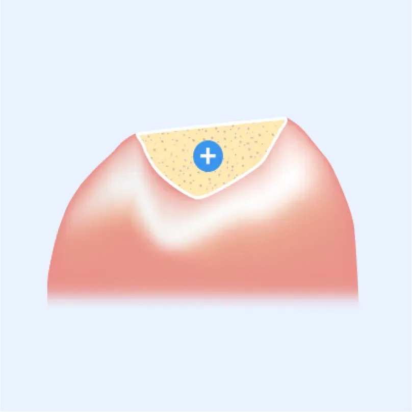 在不足部位填充骨移植材料的示意图