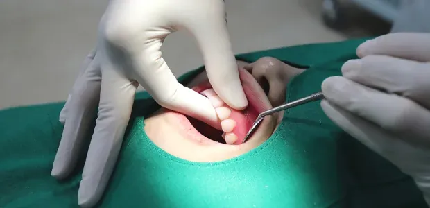 牙龈按摩