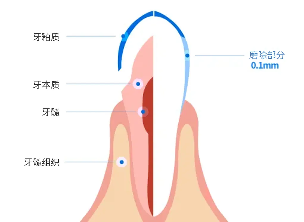 牙齿剖面图，标示牙釉质、牙本质、牙髓、牙髓组织及表面磨除部分0.1mm