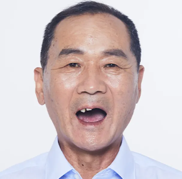 郑**（60多岁） 治疗前