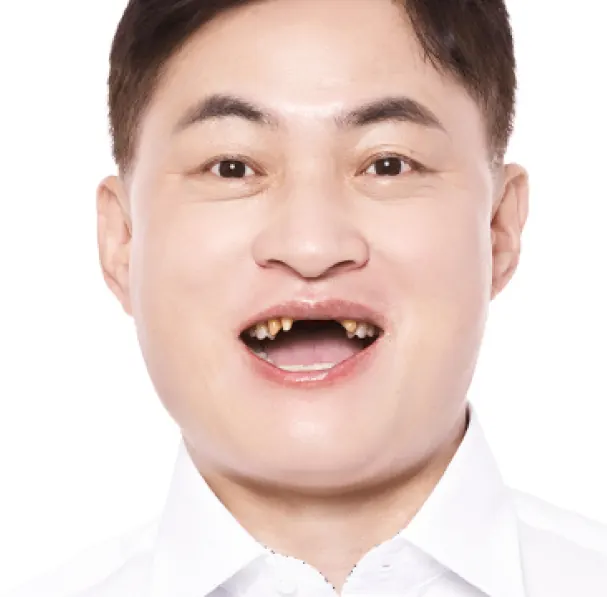 李**（40多岁） 治疗前
