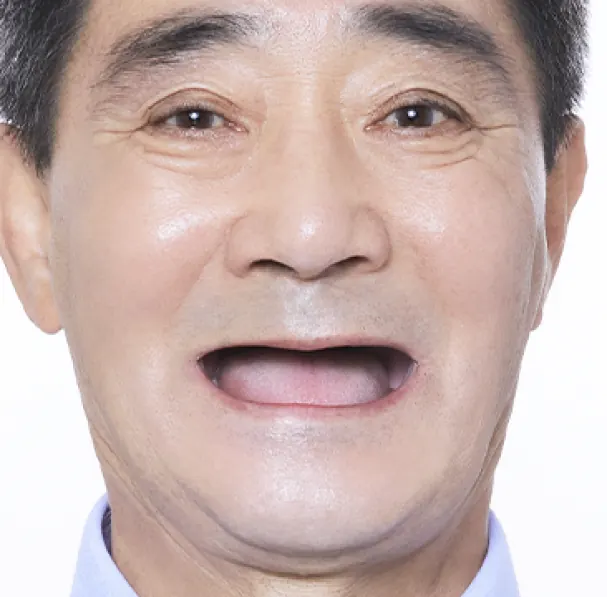 玉**（60多岁） 治疗前