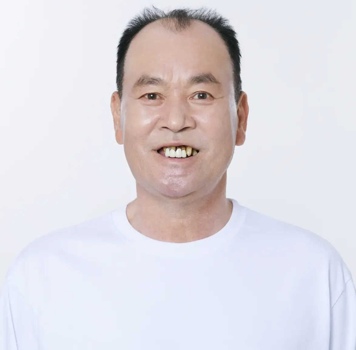 金**（60多岁） 种植牙（首尔总院） 治疗前
