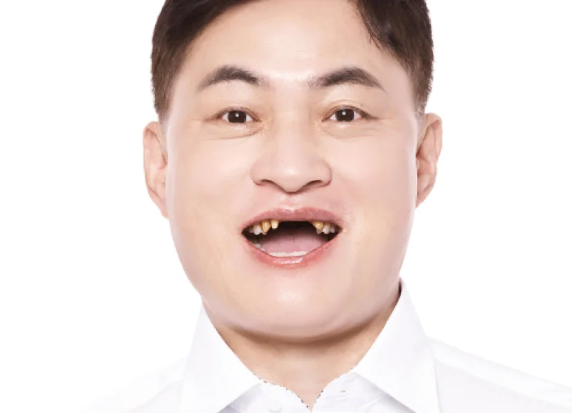 李OO 治疗前照片